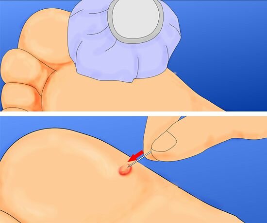 Get-Rid-of-Warts