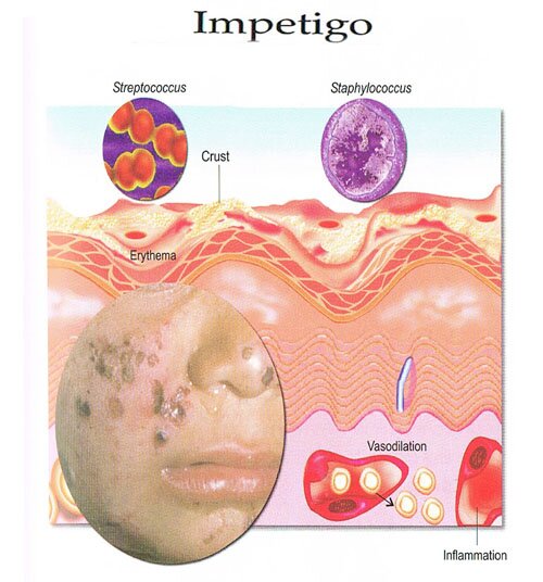 Impetigo